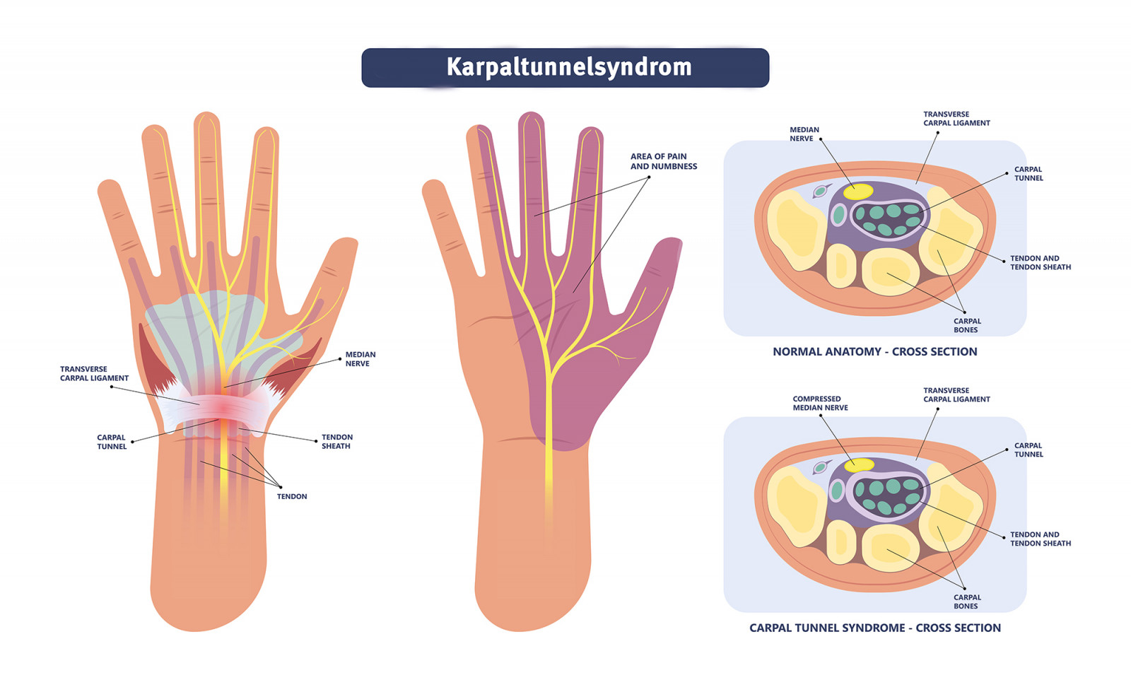 Karpaltunnelsyndrom2