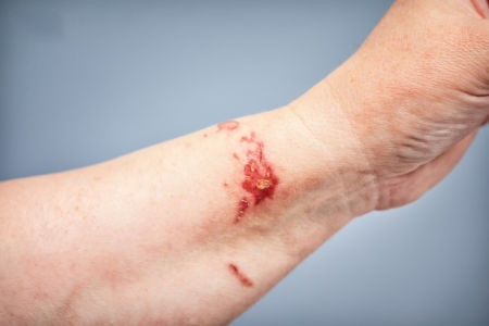 Cantharis bei Verbrennungen