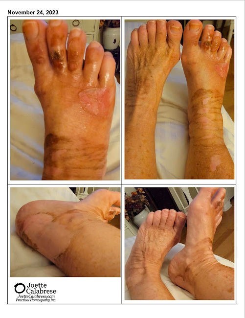 Füße mit Brandblasen