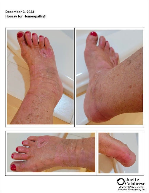 Füße mit verheilenden Brandverletzungen, roter Nagellack