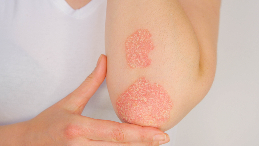Photo of an elbow with psoriasis