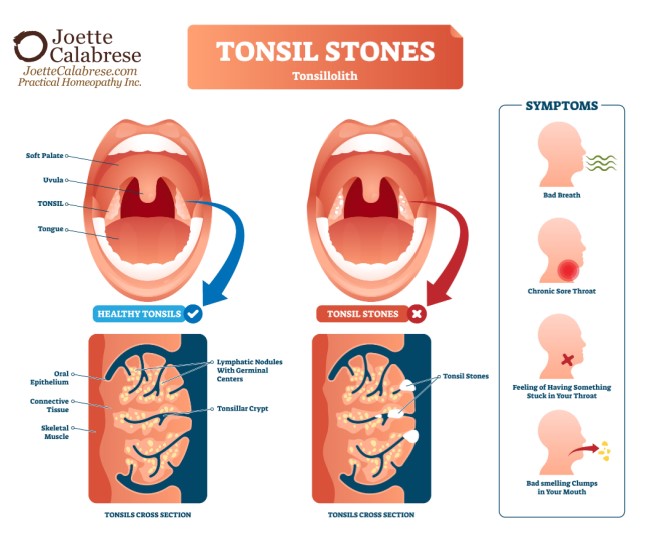 Schema Rachenraum und Symptome für Mndelsteine